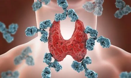 La diferencia entre hipotiroidismo y tiroiditis de Hashimoto
